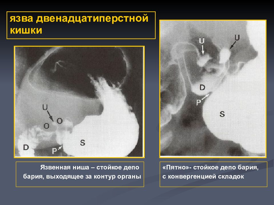 Язвенная болезнь желудка патофизиология презентация