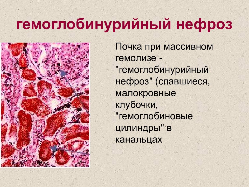 Нефроз. Миоглобинурийный нефроз. Гемоглобиновый нефроз. Гемоглобинурийный нефроз патанатомия. Острый пигментный нефроз это.