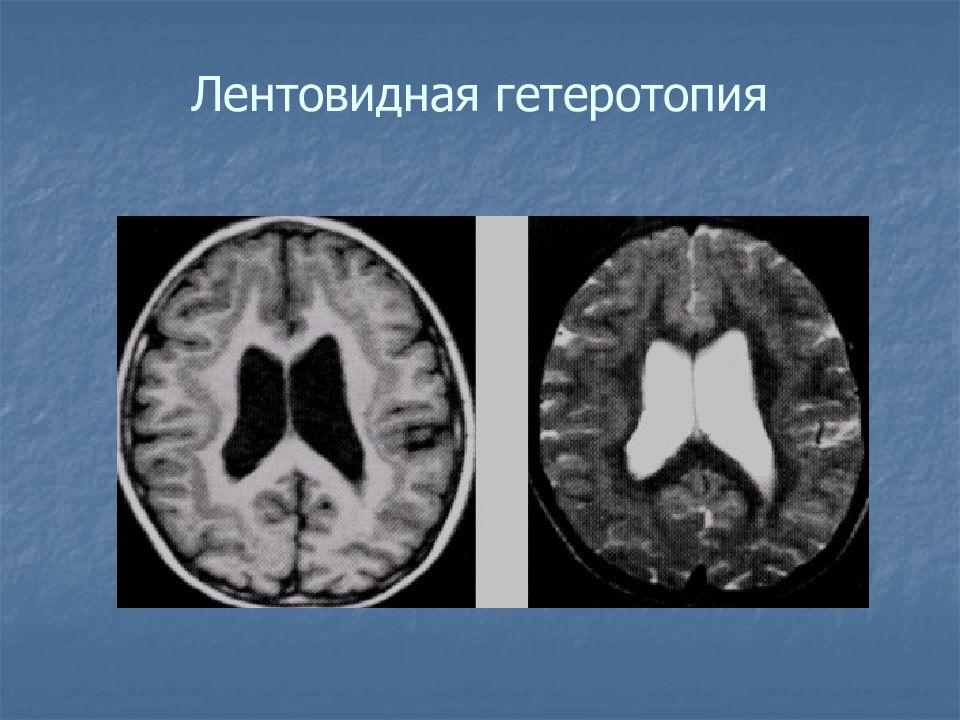 Гетеротопия. Лентовидная гетеротопия. Гетеротопия серого вещества мрт. Гетеротопия головного мозга. Аномалии головного мозга.