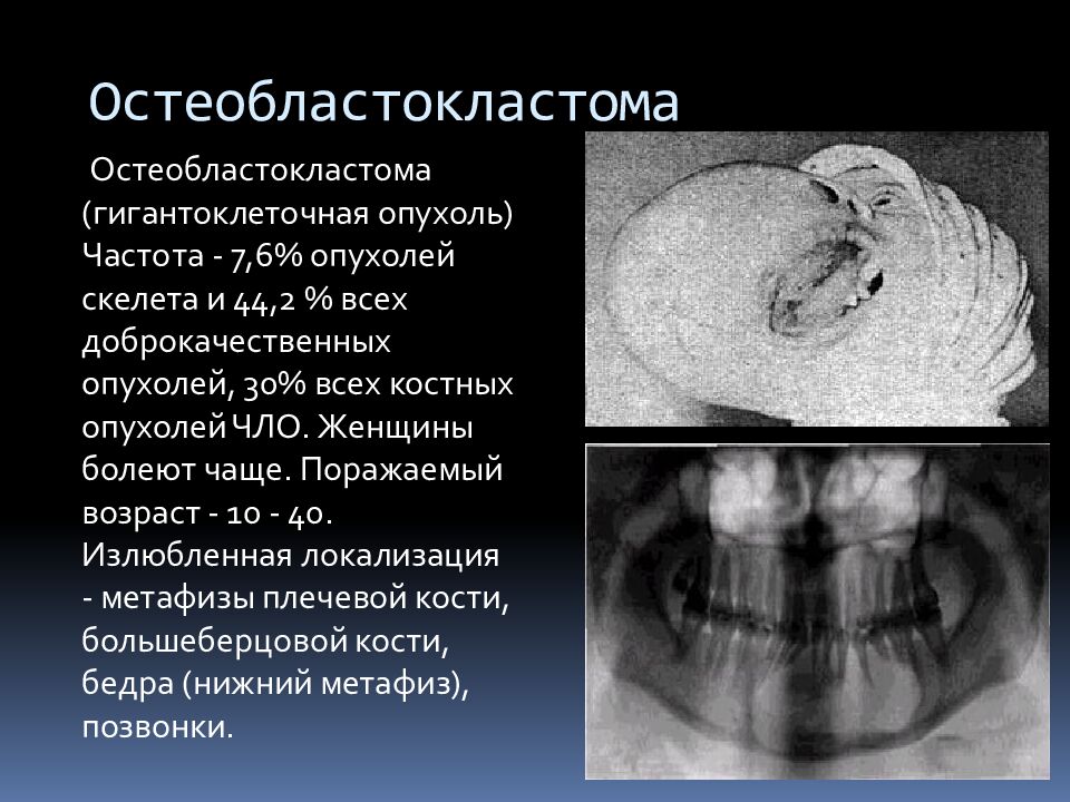 Остеобластокластома