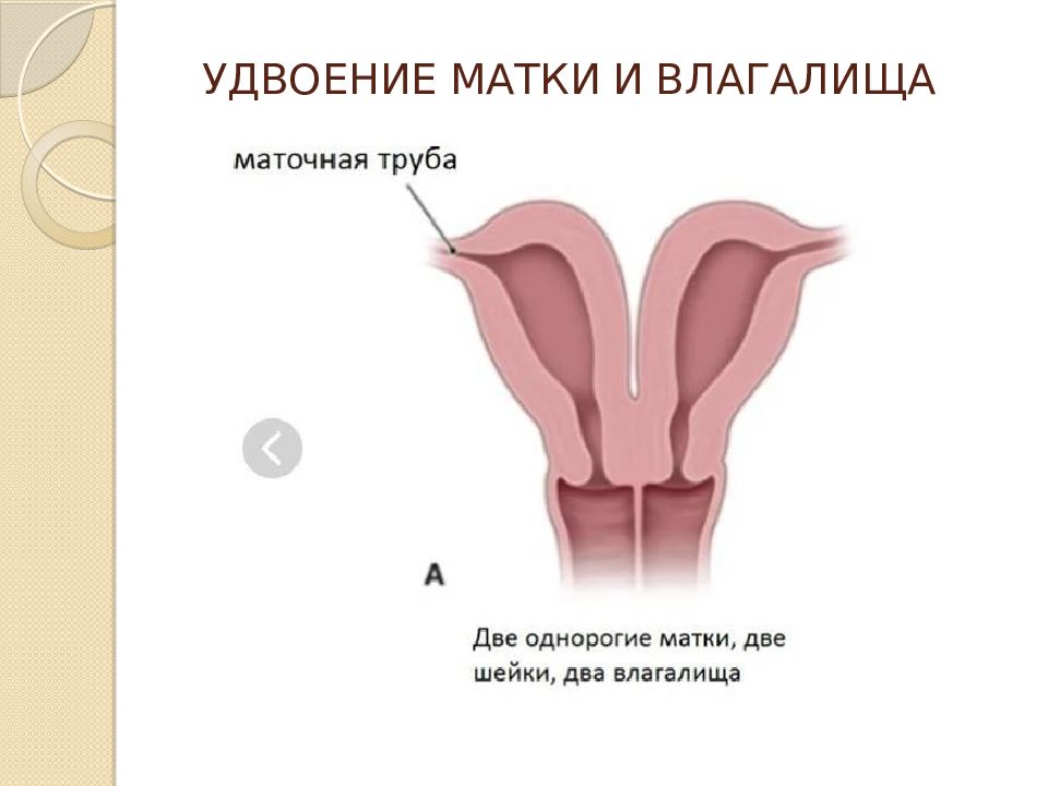 Удвоение влагалища фото