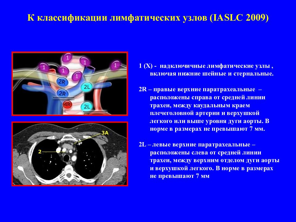 Паратрахеальные лимфатические узлы. Лимфоузлы классификация. Классификация лимфатических узлов. Классификация лимфатических узло. Надключичные лимфоузлы кт.