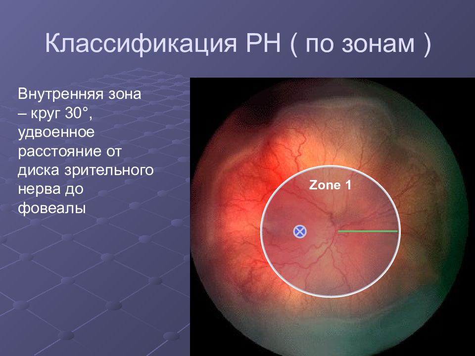 Ретинопатия недоношенных презентация