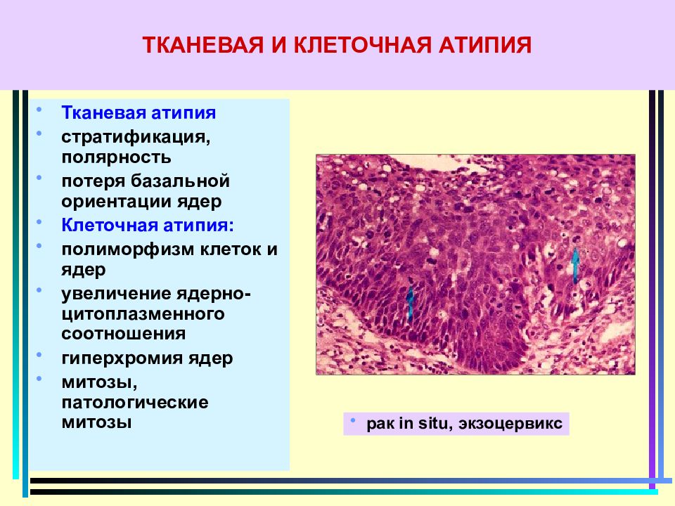 Отсутствуют клетки с признаками атипии. Клеточная атипия. Клеточная и ядерная атипия. Признаки тканевой атипии.
