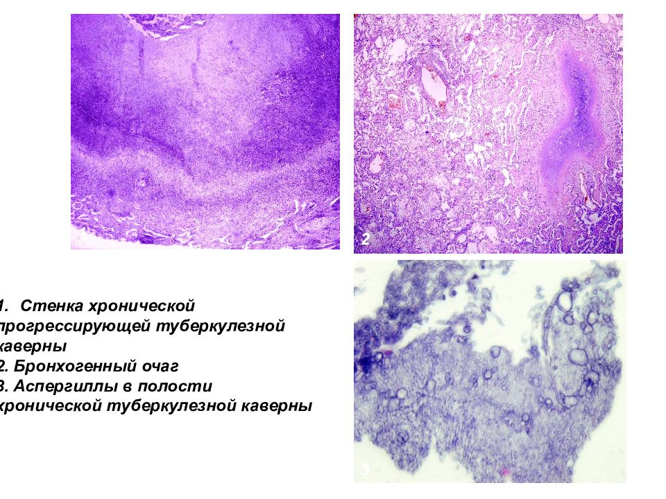 Туберкулезная каверна микропрепарат рисунок