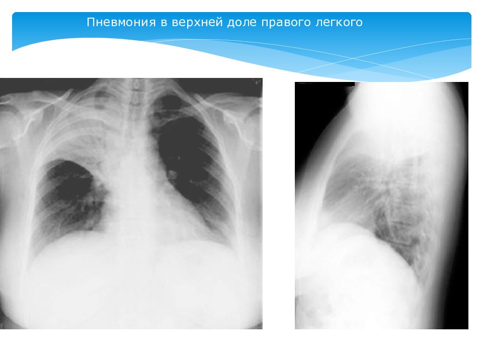Изменения в верхней доле легкого. Рентгенография крупозной пневмонии. Долевая пневмония рентген. Правосторонняя очаговая пневмония рентген. Крупозная пневмония рентгенограмма.