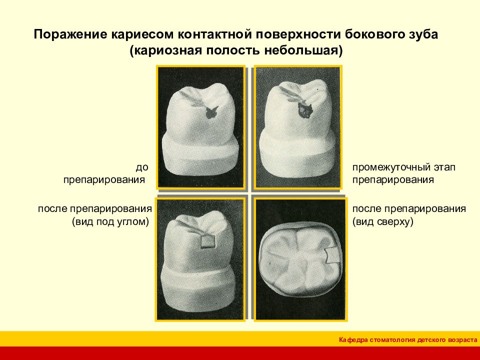 Классификация кариозных полостей по блэку презентация