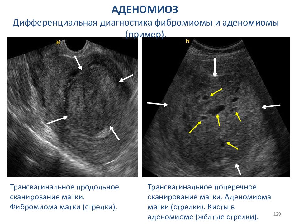 1 фаза эндометрия. Аденомиоз Узловая форма УЗИ. Узловая форма аденомиоза матки на УЗИ. Эндометриоз Узловой формы на УЗИ.