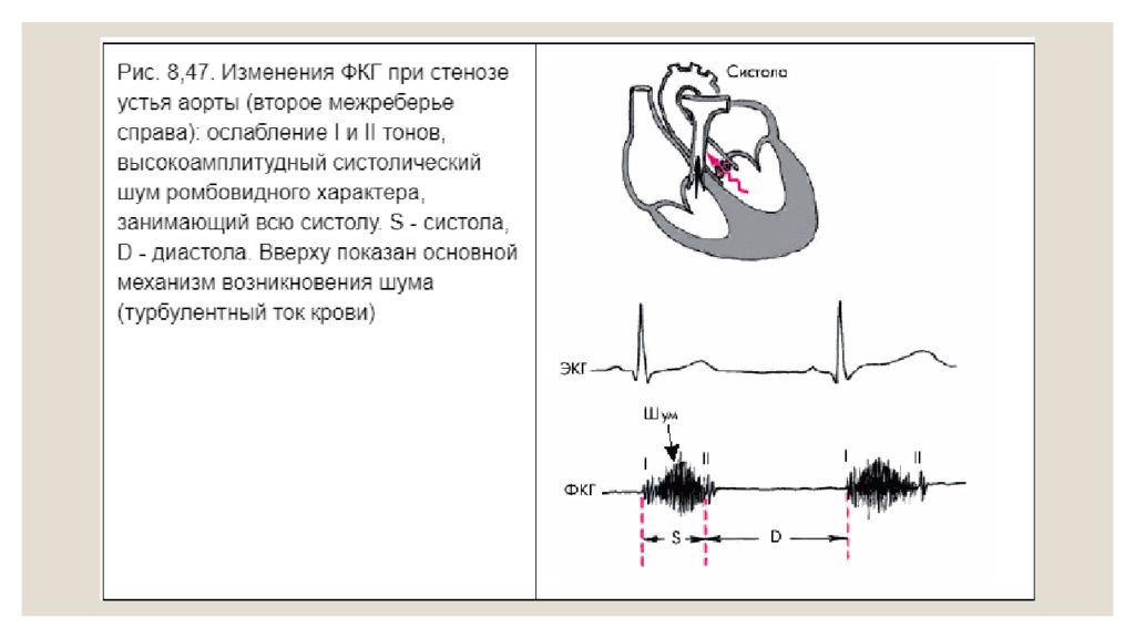 Справа устья. Фонокардиография стеноза устья аорты. ФКГ стеноз устья аорты. Стеноз устья аорты фонокардиограмма. ФКГ при стенозе устья аорты.