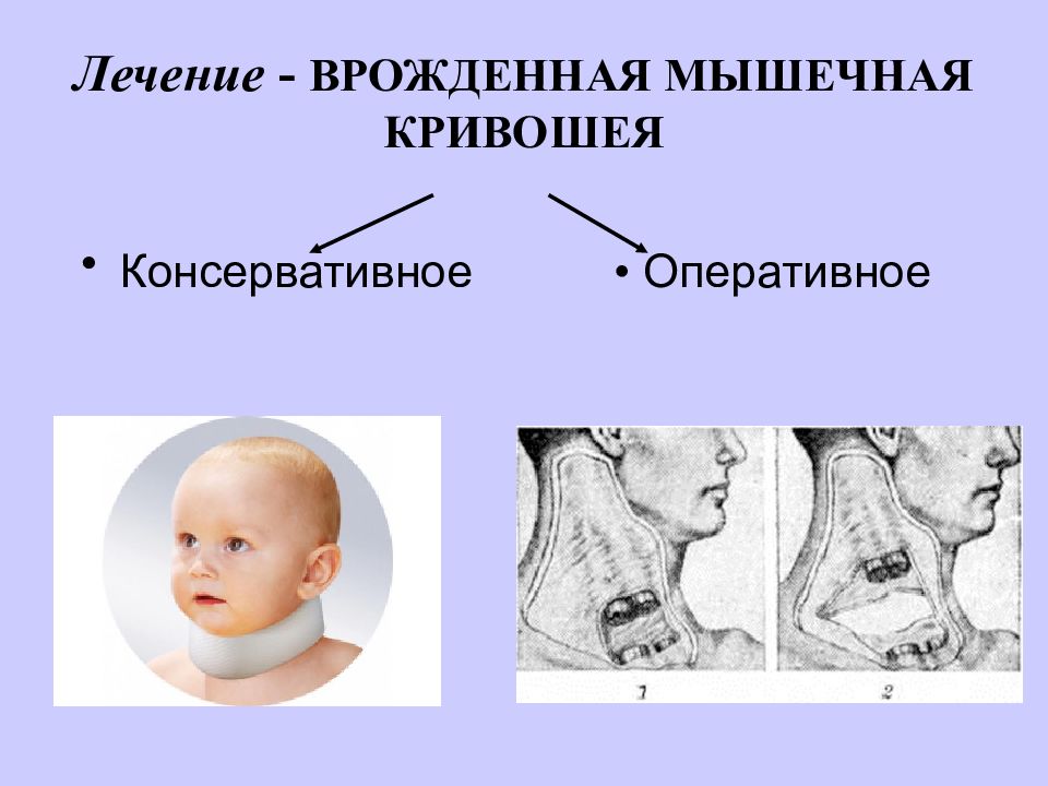 Врожденная мышечная кривошея презентация