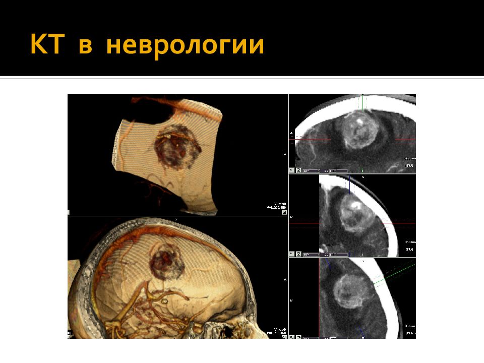 Компьютерная томография в неврологии презентация