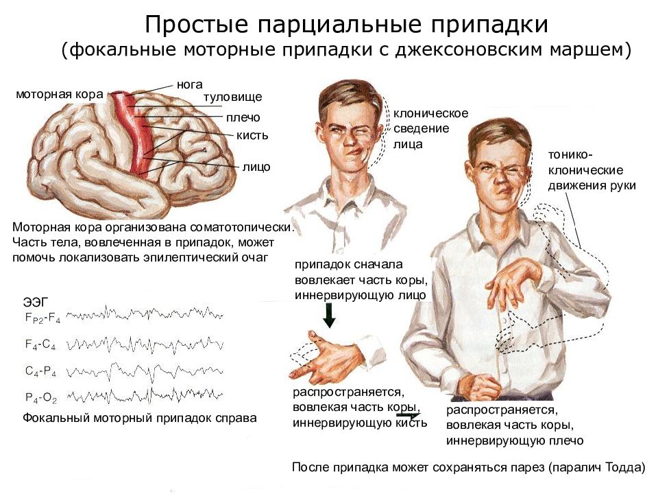 Джексоновские приступы. Джексоновские эпиприступы. Фокальные моторные приступы. Джексоновские двигательные припадки. Простые парциальные припадки эпилепсии симптомы.