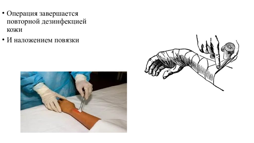 Первичная рана. Первичная хирургическая обработка раны картинки. Первичная хирургическая перевязка раны алгоритм.