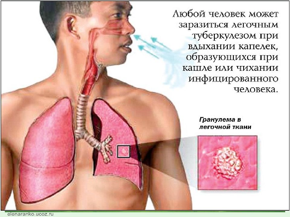 Туберкулез заразен