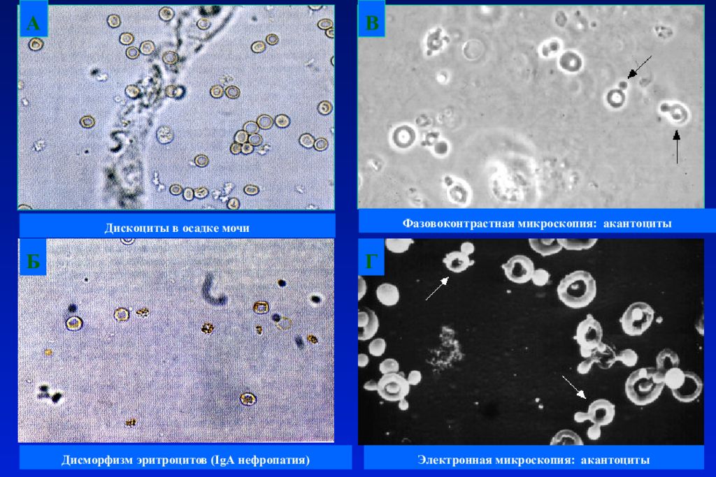 Эритроциты в моче. Фазовоконтрастная микроскопия мочевого осадка. Эритроциты в моче микроскопия. Эритроциты в моче микроскопия осадка. Макрофаги в моче микроскопия.