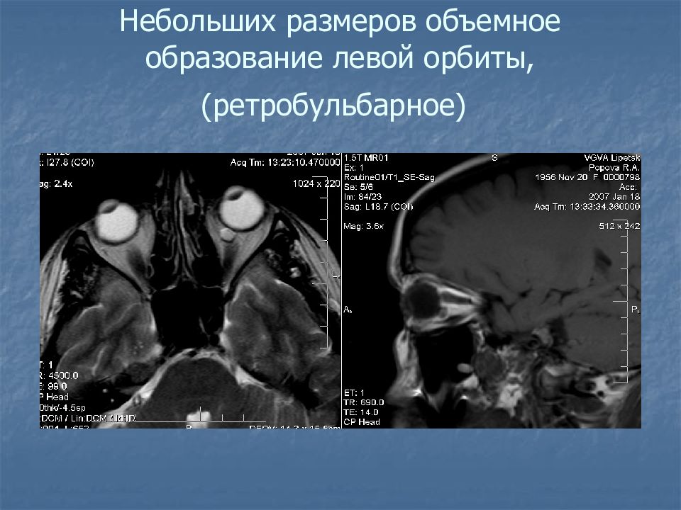 Образование левой. Объемное образование орбиты мрт. Ретробульбарное образование левой орбиты.