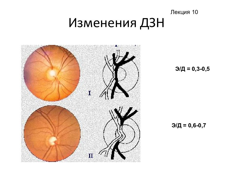 Экскавация это. Экскавация диска зрительного нерва норма. Диск зрительного нерва анатомия. Изменения зрительного нерва при глаукоме. Пигмент диска зрительного нерва.
