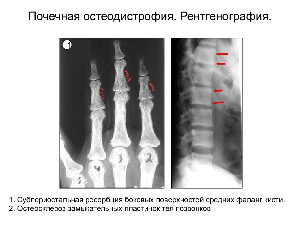 Остеосклероз тел позвонков