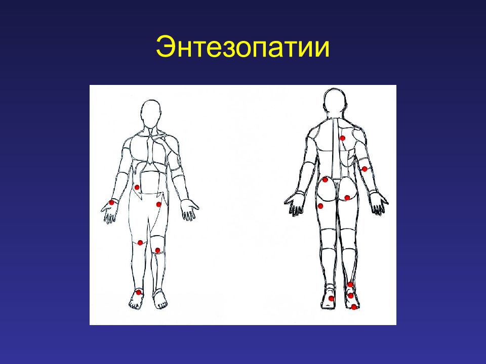 Энтезопатия что это такое. Локализация энтезитов.