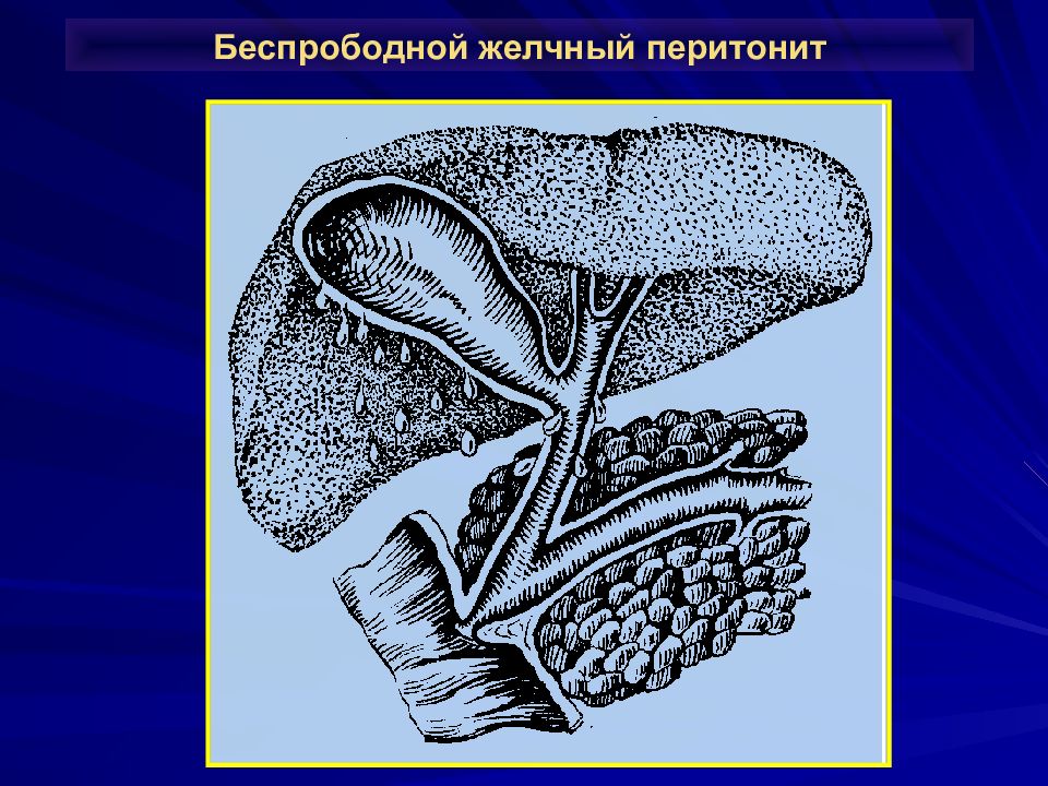 Механическая желтуха презентация по хирургии