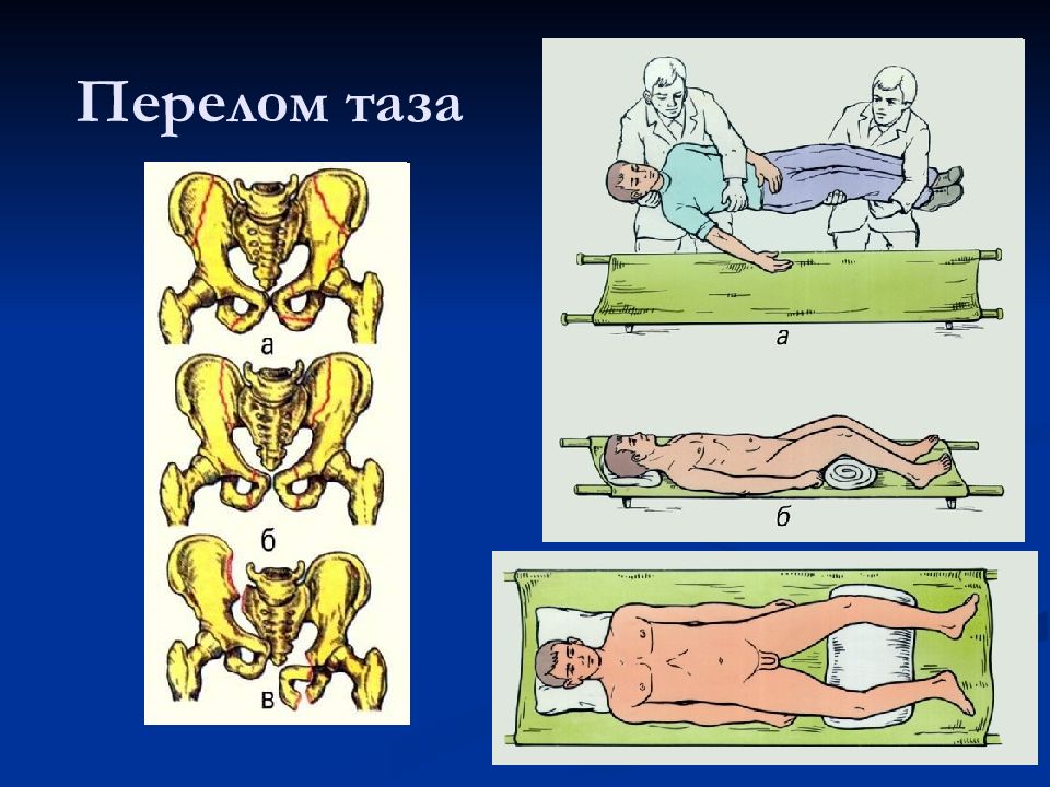 Перелом таза. Перелом костей таза на человеке. Положение человека при переломе таза. Переломы таза травматология.