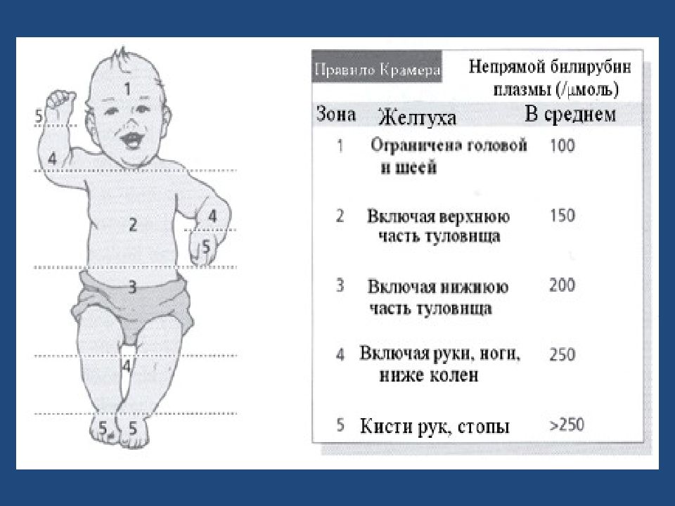 Презентация желтуха у новорожденных