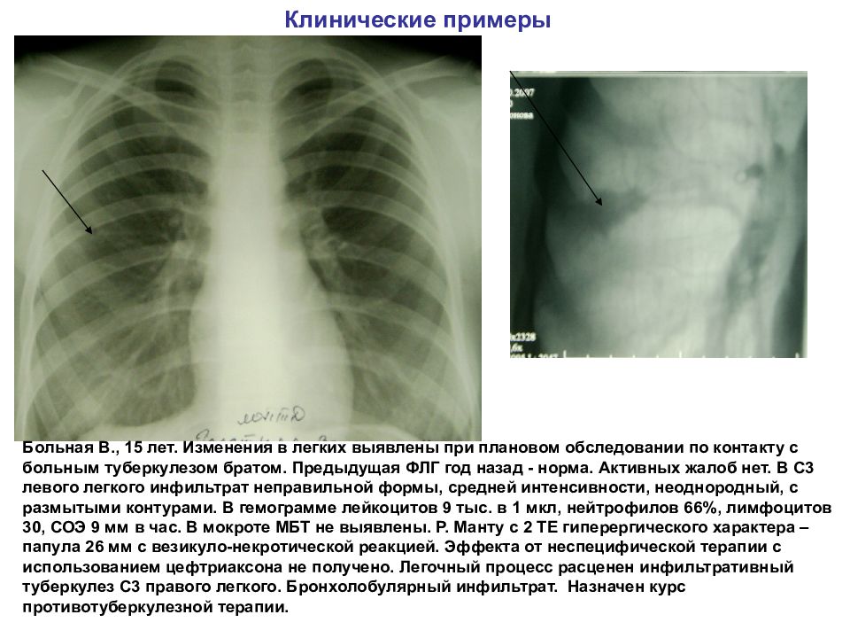 Пневмония и туберкулез презентация