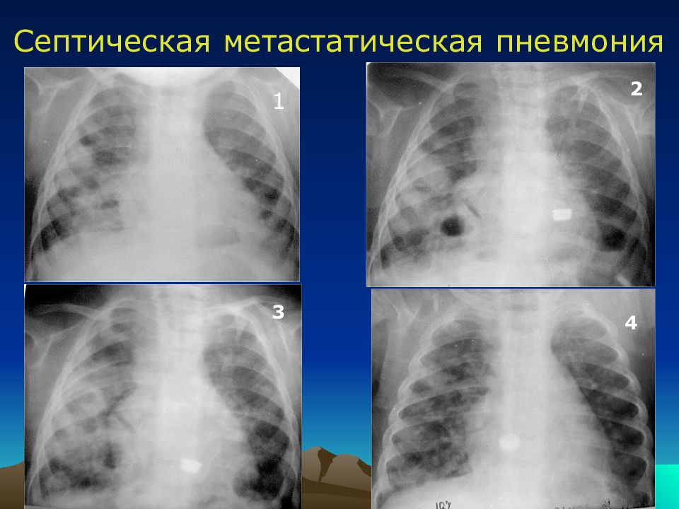 Острая гнойная деструктивная пневмония у детей презентация