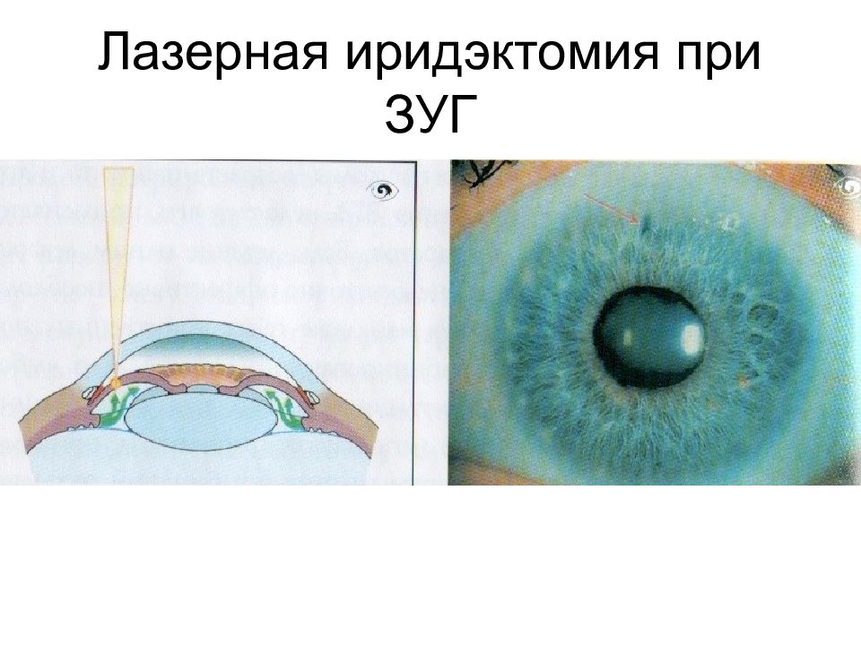 Патология внутриглазного давления презентация