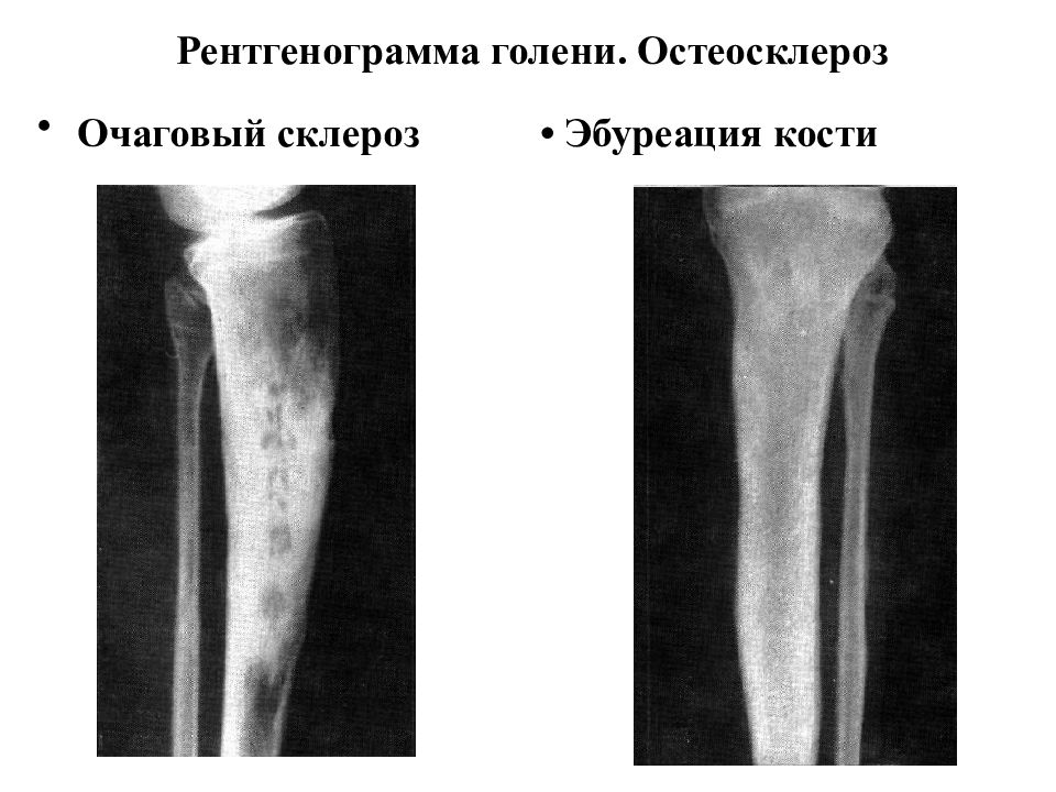 Очаговые изменения костей. Очаговый остеосклероз большеберцовой кости. Остеосклероз кости рентген. Локальный остеосклероз бедренной кости. Остеосклеротический очаг бедренной кости.
