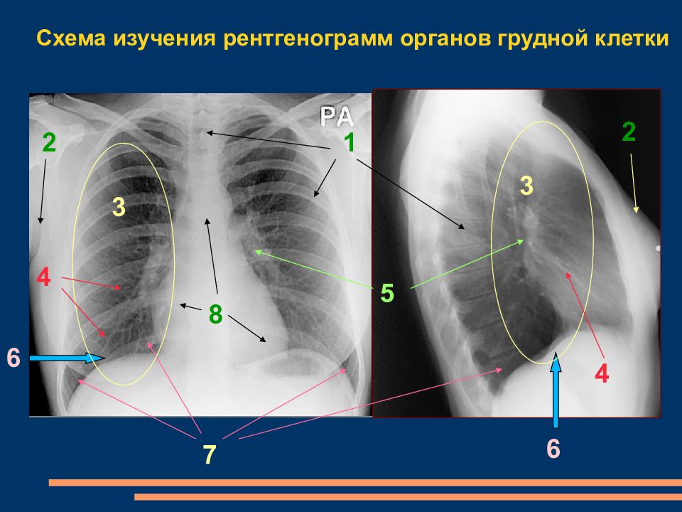 Рентгенограмма в боковой проекции. Рентген грудной клетки в боковой проекции норма. Рентген грудной клетки боковая проекция. Рентген грудной клетки в правой боковой проекции. Рентгенограмма органов грудной клетки в боковой проекции.