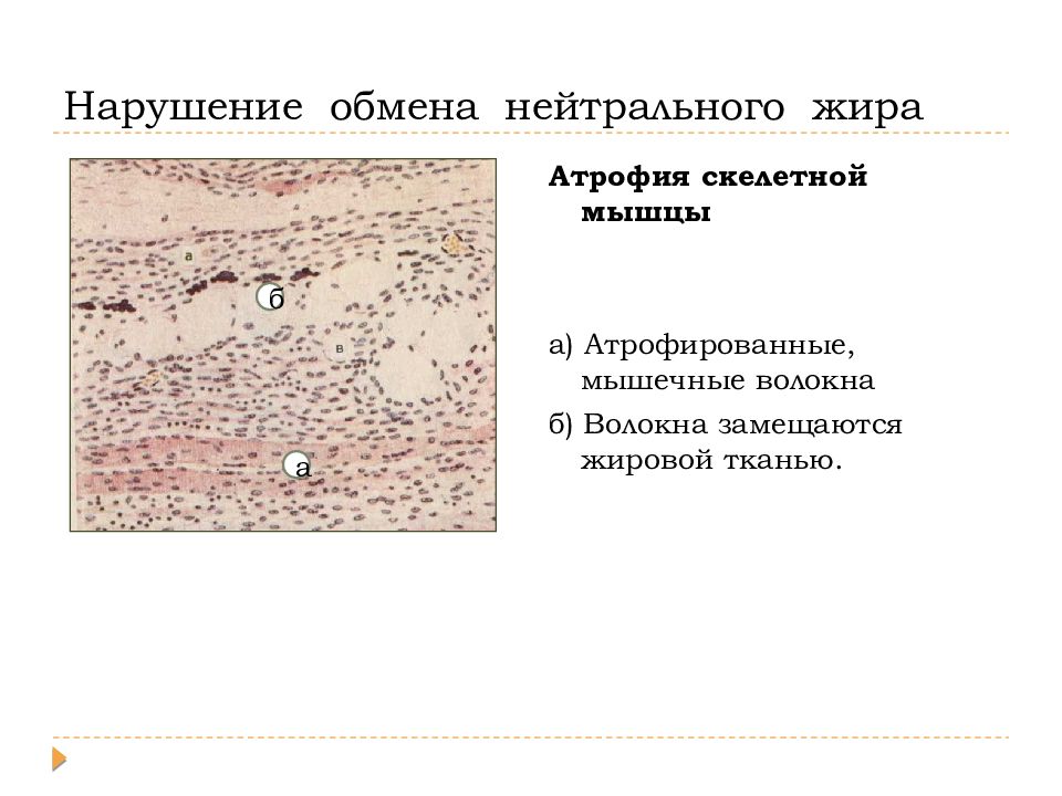 Нарушение тканей. Нарушение обмена нейтрального жира при ожирении. Нарушение обмена жира в жировой ткани. Нарушения обмена мышц.