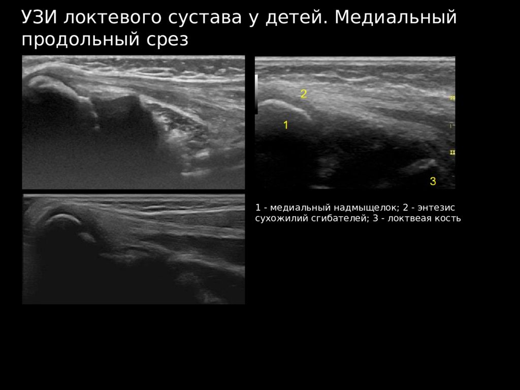 Протокол узи локтевого сустава образец