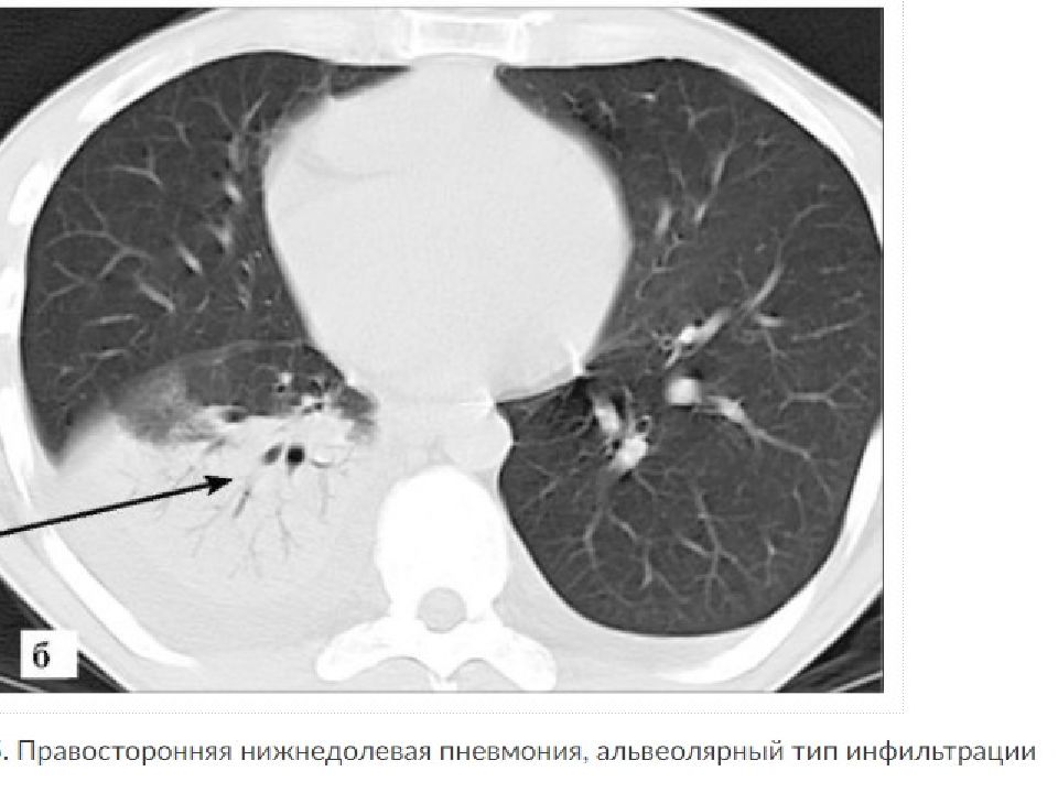 Кт картина пневмонии