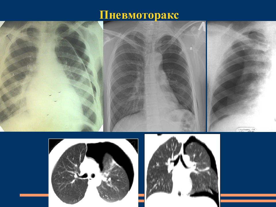 Гидроторакс на кт. Осумкованный гидроторакс. Плащевидный пневмоторакс. Плащевидный гидроторакс. Осумкованный пневмоторакс на кт.