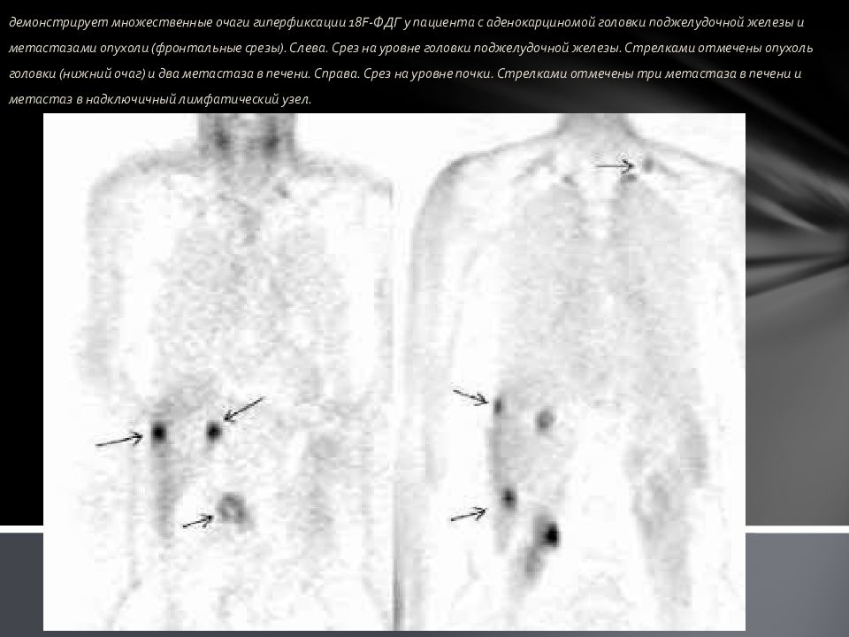 Гиперфиксация рфп что это такое. Очаг гиперфиксации РФП что это. Остеосцинтиграфия очаги гиперфиксации.