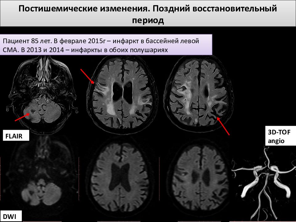 Ишемические изменения головного мозга. Ишемический инсульт в бассейне левой средней мозговой артерии. Ишемический инсульт на кт головного мозга. Бассейн средней мозговой артерии на кт. Постишемические изменения на кт.
