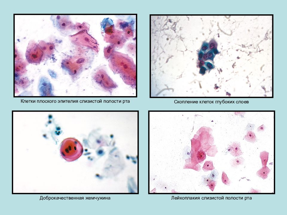 Рак плоских клеток. Клетки эпителия полости рта. Клетки эпителия слизистой полости рта. Цитологическое исследование полости рта. Плоская клетка.