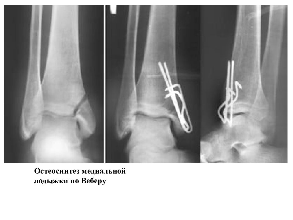 Перелом наружной лодыжки рисунок