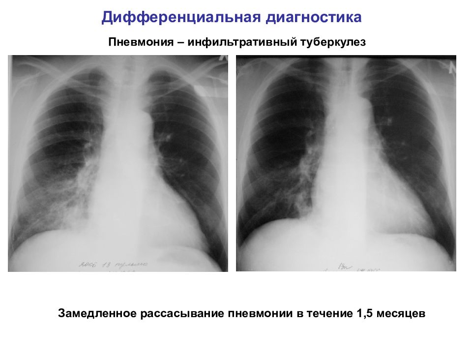 Инфильтративный туберкулез презентация