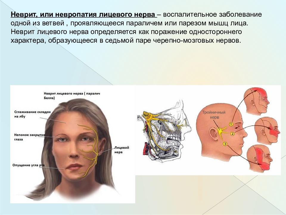 Неврит лицевого нерва картинки