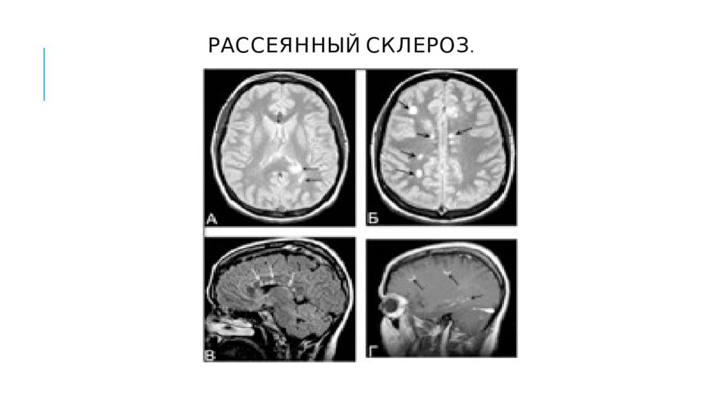 Рассеянный склероз красноярск. Рассеянный склероз неврология. Клинические проявления рассеянного склероза. Рассеянный склероз неврология симптомы. Мрт в неврологии.