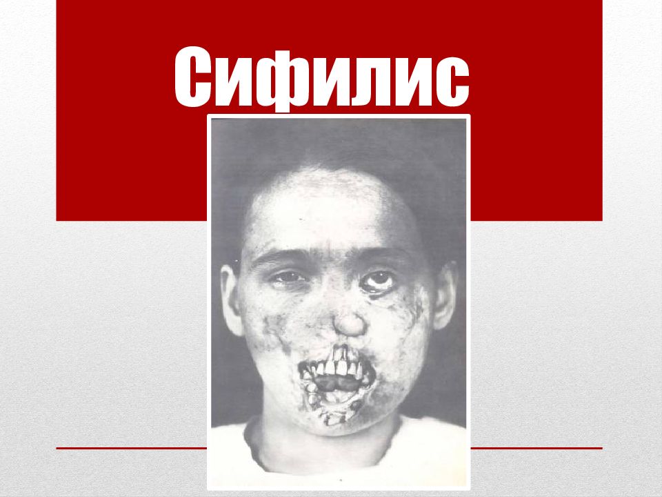 Сифилис