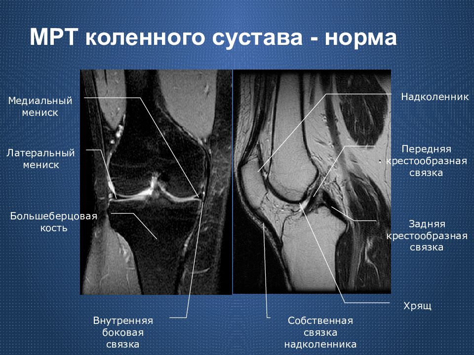 Мрт коленного сустава картинки