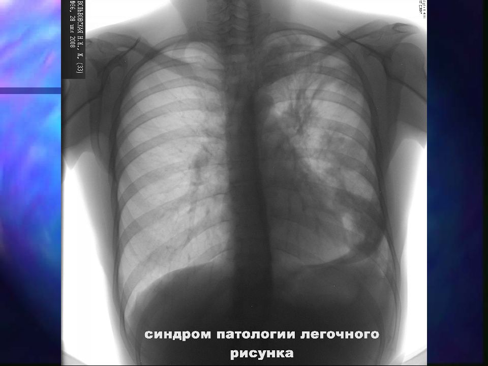 Фиброз что это. Патология легочного рисунка. Фиброз плевральные наслоения. Синдром патологии легочного рисунка. Фиброз легких на флюорографии.