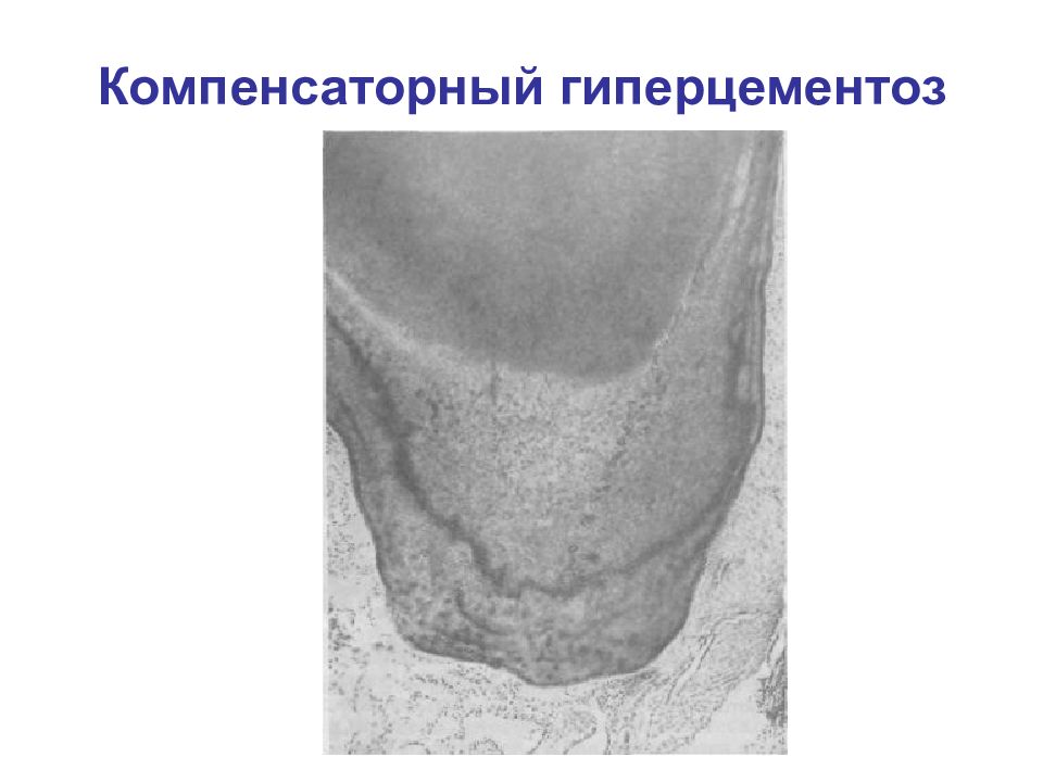 Твердая ткань зуба. Гиперцементоз корня зуба. Гиперцементоз гистология. Гиперцементоз Периодонтальная щель.