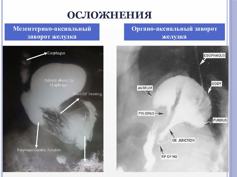 Грыжа пищевого отверстия фото