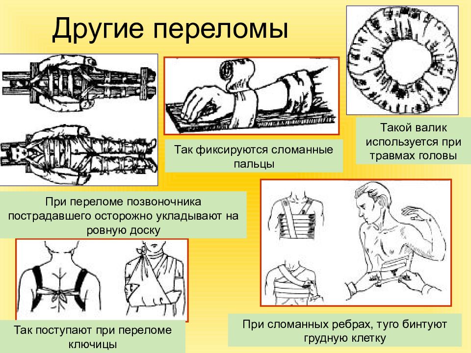 Первая помощь при ушибах растяжениях связок вывихах переломах презентация