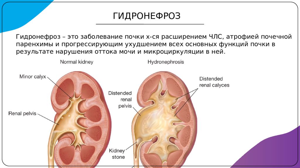 Что такое гидронефроз почки у взрослых. Гидронефротическая трансформация почки. Врожденный гидронефроз. Степени гидронефроза на кт.