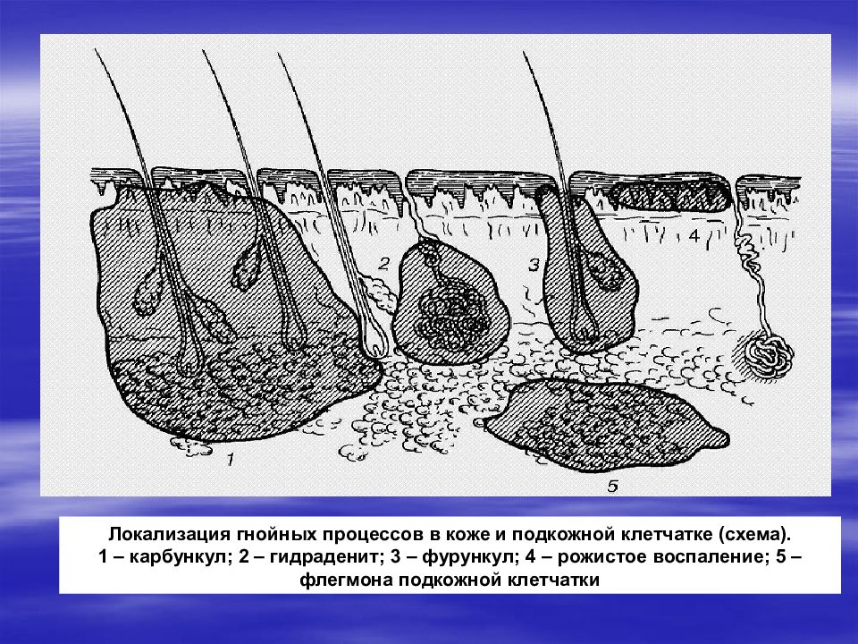 Гнойно инфекционные заболевания. Фурункул карбункул флегмона. Флегмона подкожной клетчатки. Фурункул карбункул гидраденит рожа.